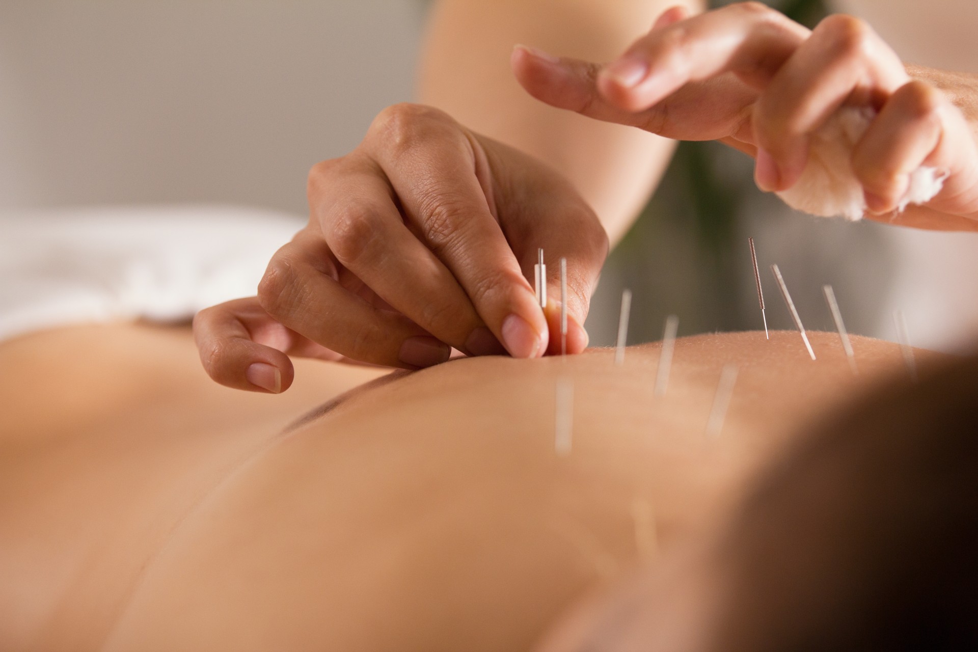 a person receiving acupuncture treatment