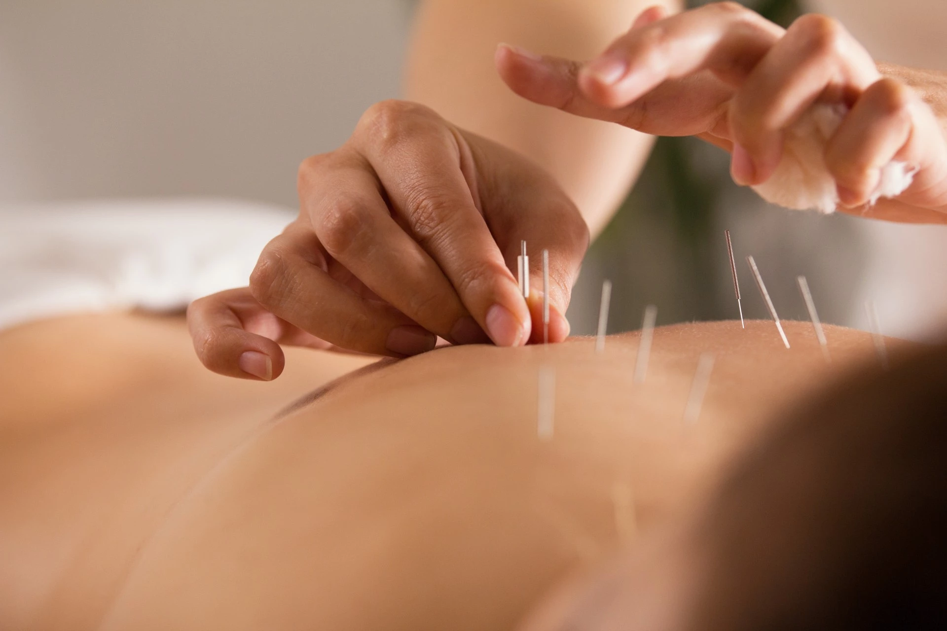 a person receiving acupuncture treatment