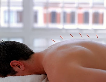 View of a man receiving acupuncture