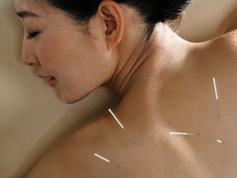 a woman with needles on her back